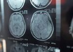 Cannabis, Cocaine, and Amphetamines Linked to Up to 174 Percent Higher Stroke Risk in Adults Younger Than 55