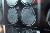 Cannabis, Cocaine, and Amphetamines Linked to Up to 174 Percent Higher Stroke Risk in Adults Younger Than 55